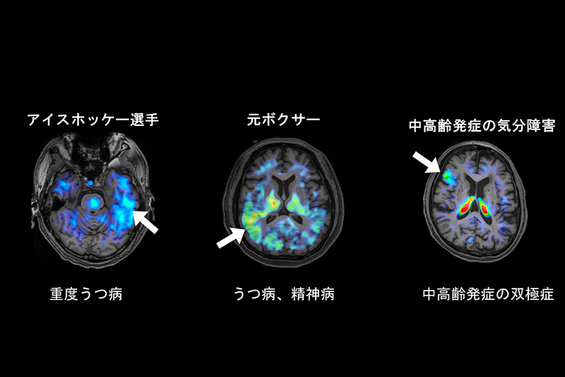 精神障害病態解明へ…QST、早期発見に道｜ニュースイッチ by 日刊工業新聞社
